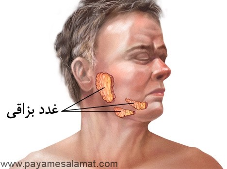 اریون ( گوشک یا خوکلک ) علائم و درمان ها