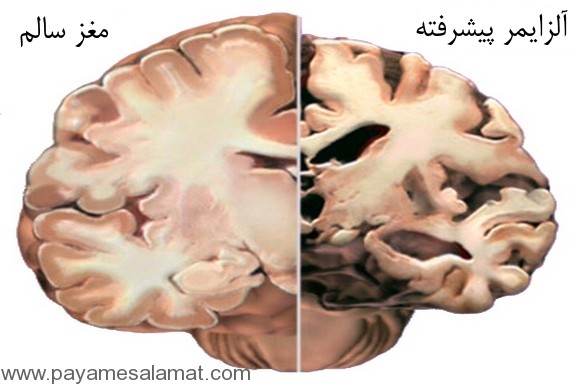 با نشانه های بیماری آلزایمر آشنا شوید