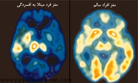 افسردگی بالینی و علائم عاطفی و فیزیکی آن