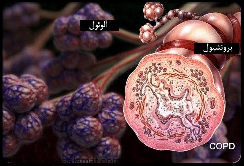 بیماری انسدادی مزمن ریوی COPD