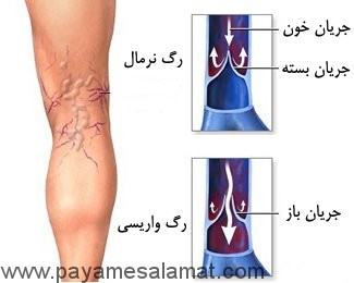 واریس چطور ایجاد شده و راه های درمان آن چیست؟