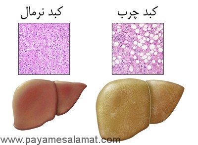 علائم بیماری کبد چرب