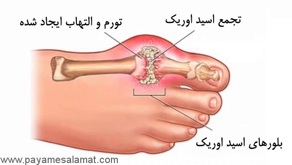 نقرس بیماری ثروتمندان