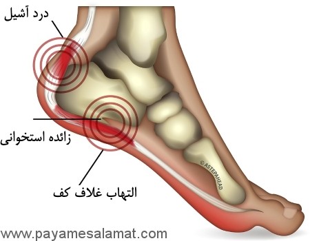 علل ایجاد درد پاشنه پا