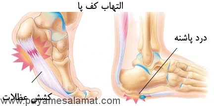 علل ایجاد درد پاشنه پا