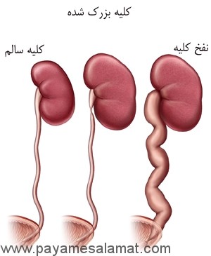 بیماری نفخ کلیه چیست؟