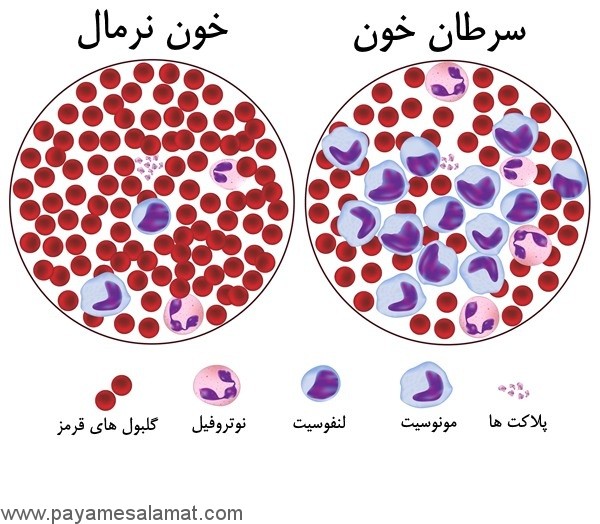 علائم لوسمی ( سرطان خون )