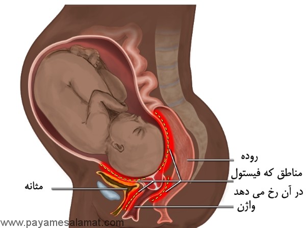 رایج ترین نشانه های زایمان طبیعی