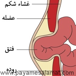 فتق شکمی و انواع آن