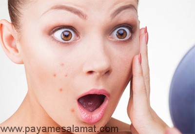 غذاهایی که ایجاد آکنه می کنند