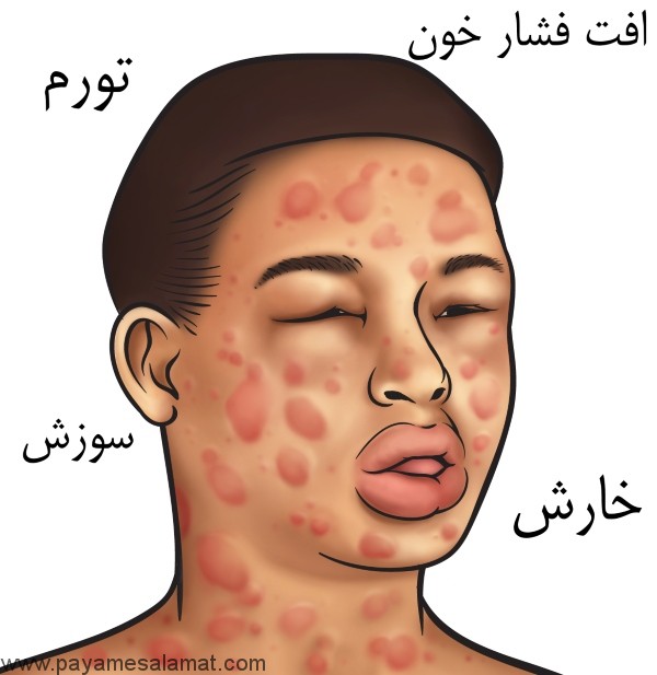 غذاهایی که موجب واکنش آلرژیک آنافیلاکسی می شوند