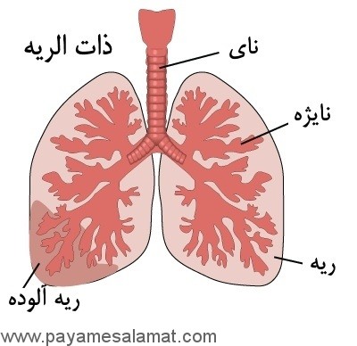 همه چیز درباره ذات الریه