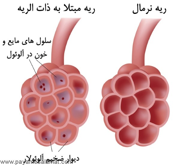 همه چیز درباره ذات الریه