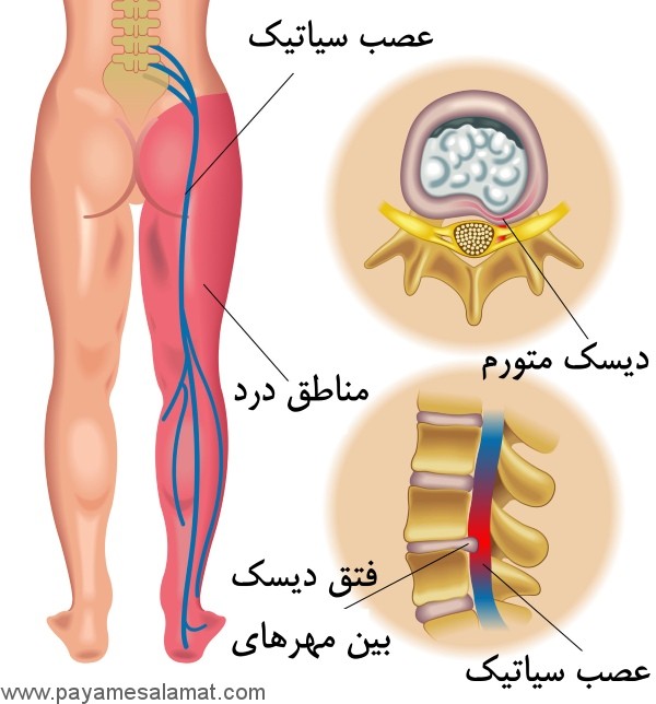 چند نسخه گیاهی برای درمان سیاتیک