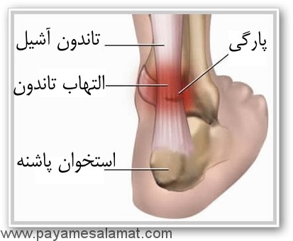 چه چیزی باعث درد مچ پا و التهاب تاندون مچ پا می شود