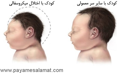 هشدارهای جدی درباره ویروس زیکا