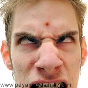 انواع آکنه از نظر شدت شکل گیری