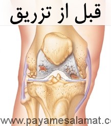 یک روش تزریقی جالب و جدید برای درمان آرتروز