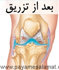 یک روش تزریقی جالب و جدید برای درمان آرتروز