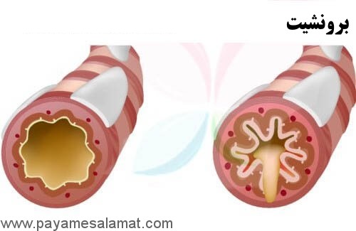 بهترین روغن ها برای درمان برونشیت