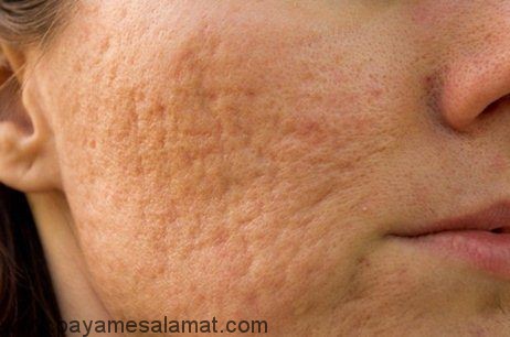 چگونه به صورت طبیعی زخم ها و جای جوش را محو کنیم؟