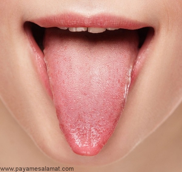 علل و درمان های طبیعی برجستگی های روی زبان