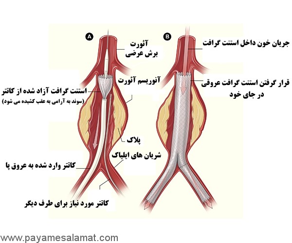 آنوریسم آئورت چیست و راه های درمان آن کدام است؟
