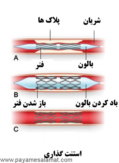 آنژیوپلاستی عروق با بالون و استنت