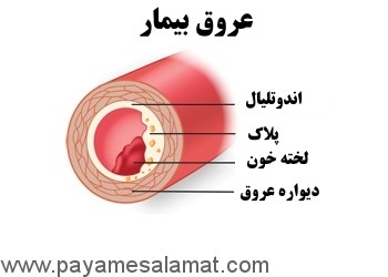 آنژیوپلاستی عروق با بالون و استنت