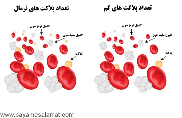 پایین بودن پلاکت خون در دوران بارداری