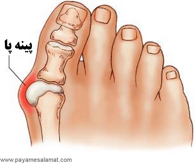 چگونه از درد پینه پا بدون جراحی خلاص شویم؟