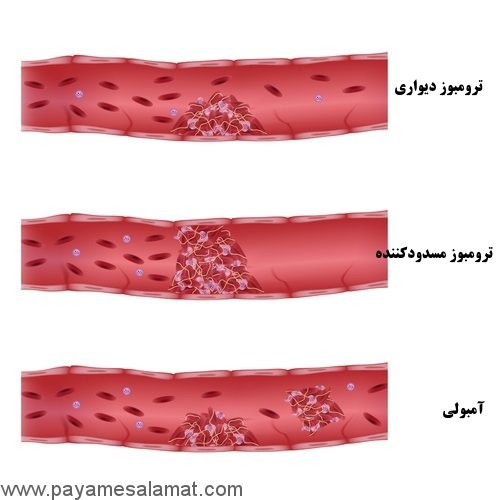 انعقاد درون رگی منتشر چیست؟
