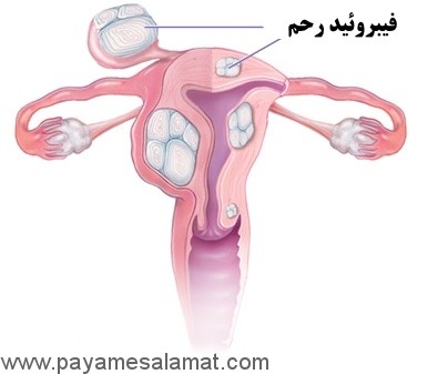هفت علامت هشداردهنده جهت تشخیص فیبروئید رحم