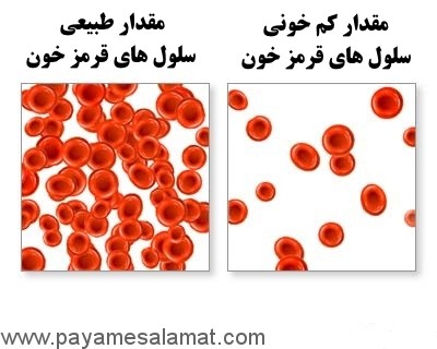 کم خونی همولیتیک