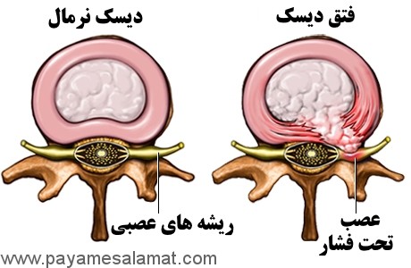 فتق دیسک بین مهرها چیست؟ چه علائمی دارد؟ و چگونه درمان می شود؟