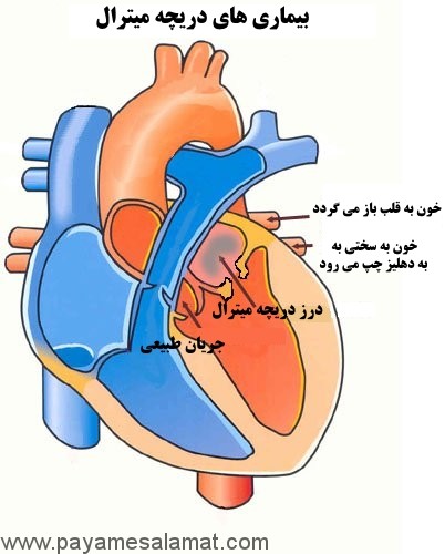 انواع و علائم بیماری های دریچه میترال