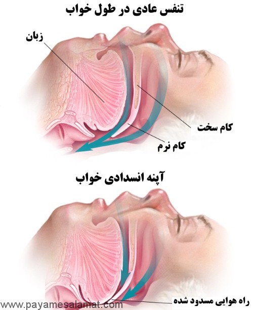 علائم آپنه بازدارنده خواب و درمان های موثر