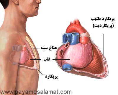 علائم و علل ابتلا به بیماری پریکاردیت