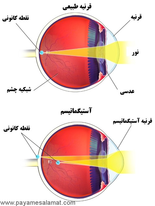 حقایقی در مورد آستیگماتیسم