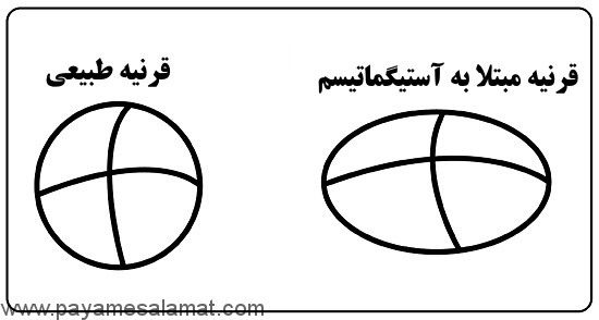 حقایقی در مورد آستیگماتیسم