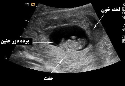 وجود لخته خون زیر جفت در سونوگرافی نشانه چیست؟