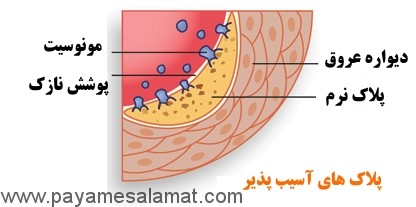 پلاک های آسیب پذیر و تاثیر آن ها بر روی حمله قلبی بر اساس آخرین مطالعات