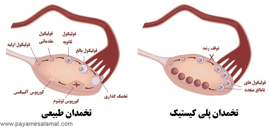 بهترین درمان های طبیعی برای سندرم تخمدان پلی کیستیک (PCOS)