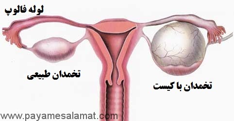انواع کیست های تخمدان و علائمی که نباید در مورد آن ها نادیده گرفته شود