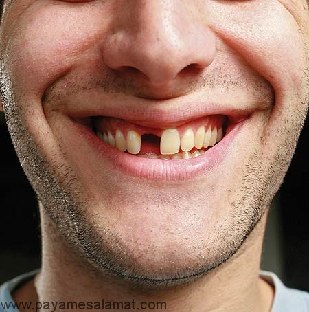 علت لق شدن دندان در بزرگسالی چیست؟