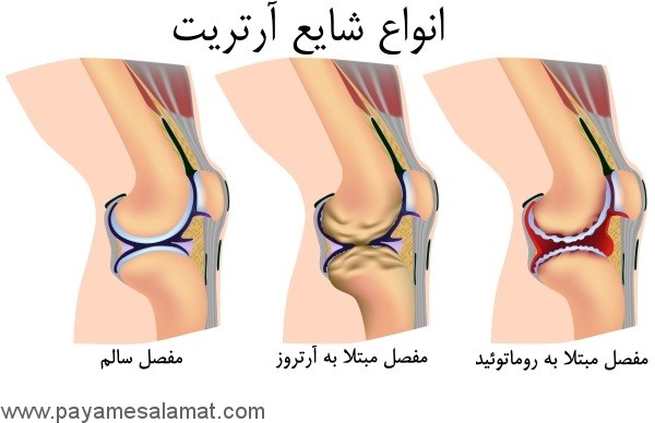 آشنایی با آرتریت و انواع آن
