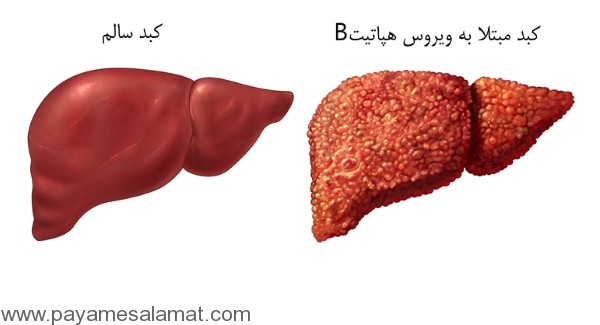 علائم و روش های انتقال بیماری هپاتیت B