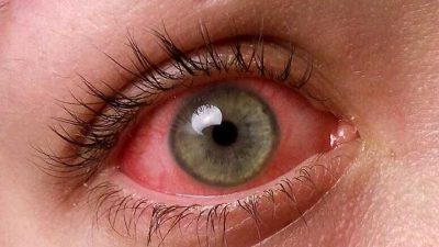عفونت های شایع که منجر به قرمزی چشم می شوند