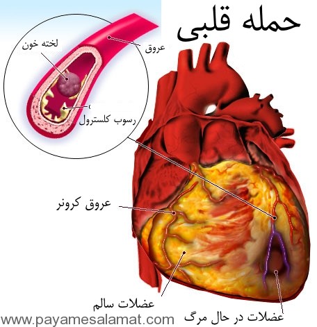 حمله قلبی چیست؟ و چه چیز باعث ایجاد حمله قلبی می شود؟