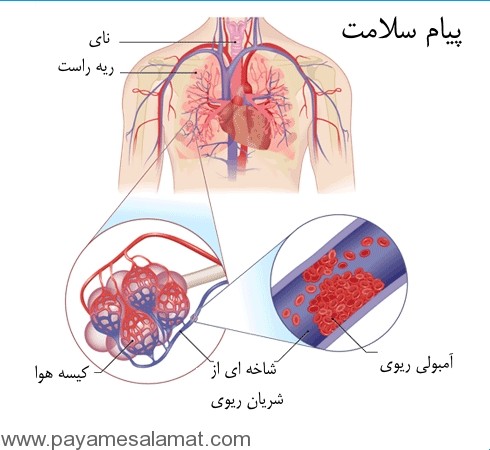 آمبولی ریوی را بهتر بشناسید